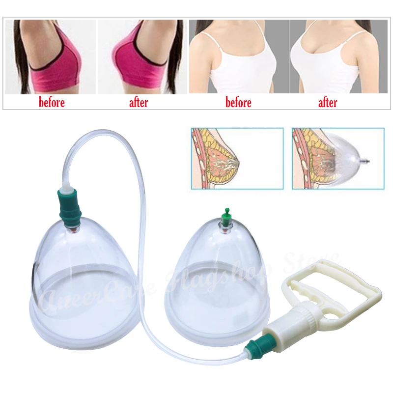 Breast Cupping