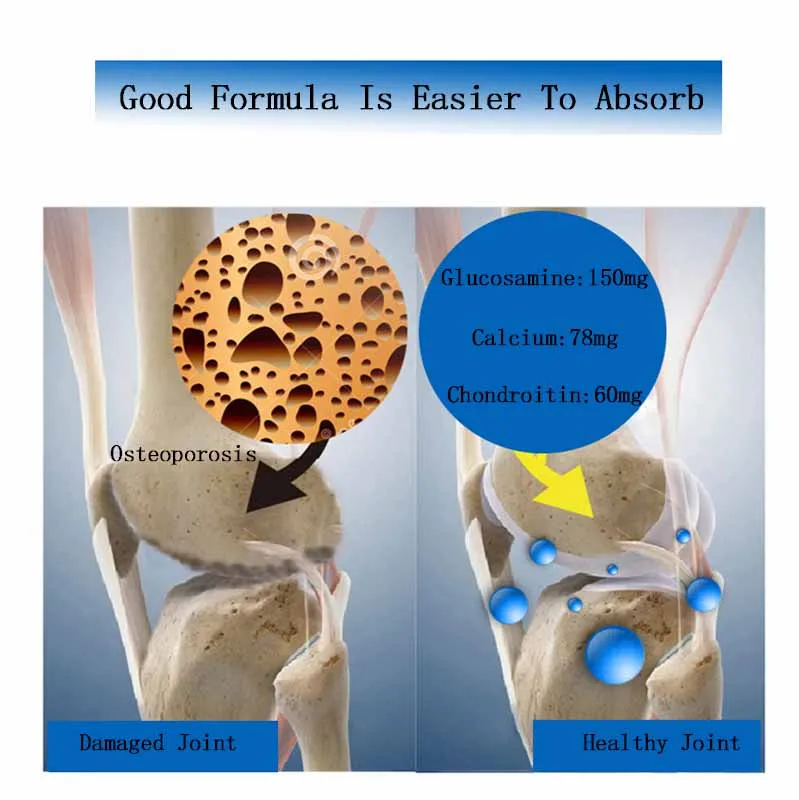 Глюкозамин хондроитин защитный сустав для пожилых людей увеличивает плотность костей снимает боль уход за костями