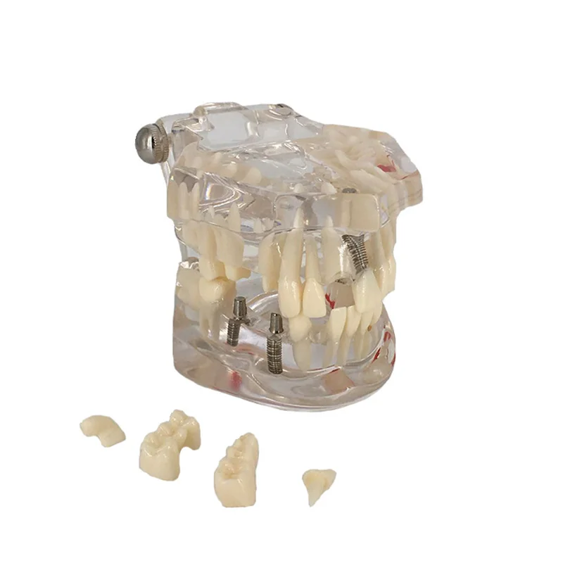 Dental Implant Disease Teeth Model with Restoration Bridge Tooth Dentist for Medical Science Dental Disease Teaching Study