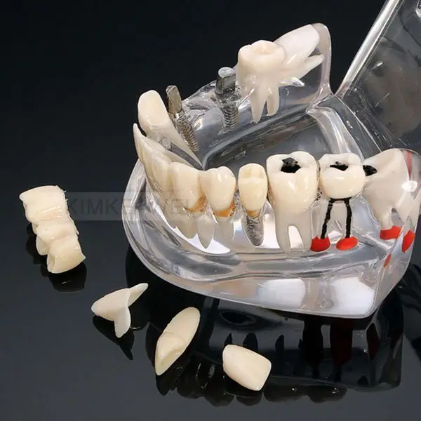 Съемный зубной имплантат, обучающая модель зубов и реставрация мостовых зубов