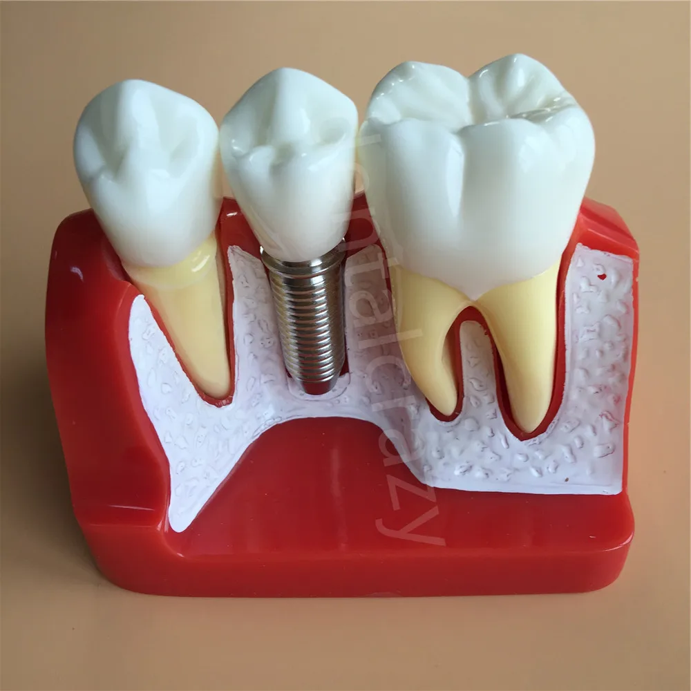 Buy 2018 Dental Teach Implant Analysis Crown Bridge