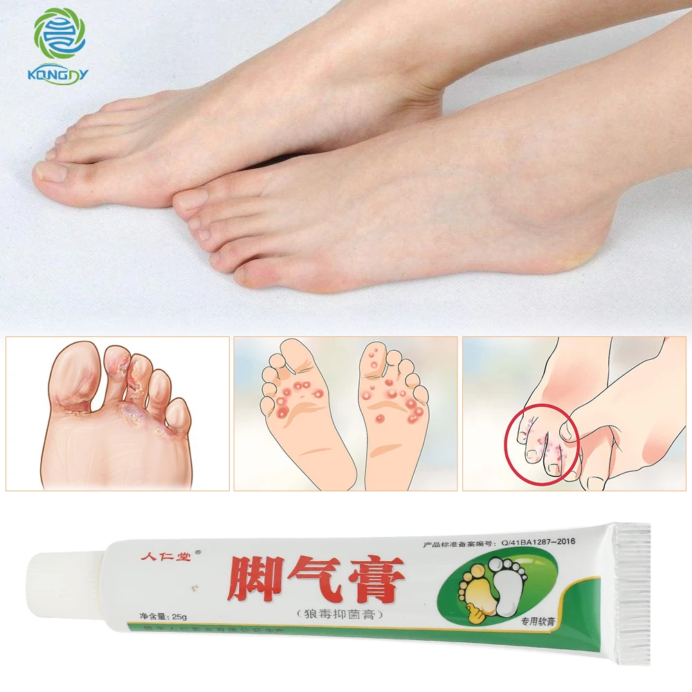 KONGDY Relieve Beriberi Cream Foot Care Chinese Herbal Patch Anti Fungal Infection Feet Repair Herbal Beriberi Treatment Cream