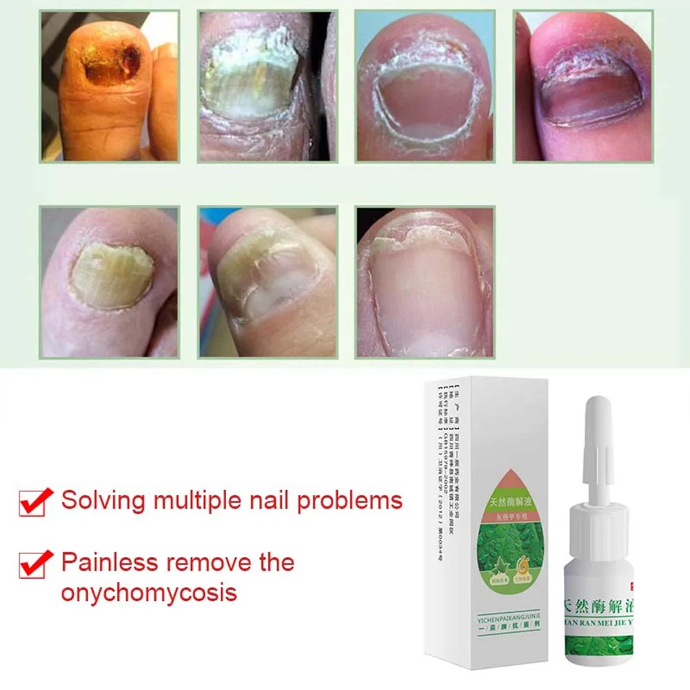 4ml Nail Fungal Treatment Liquid Onychomycosis Removal Anti Fungus Nails Repair Foot Care HS11