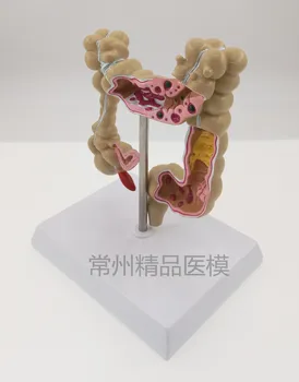 

Colon pathological model Colorectal lesions intestinal Specimen large intestine anatomy teaching model