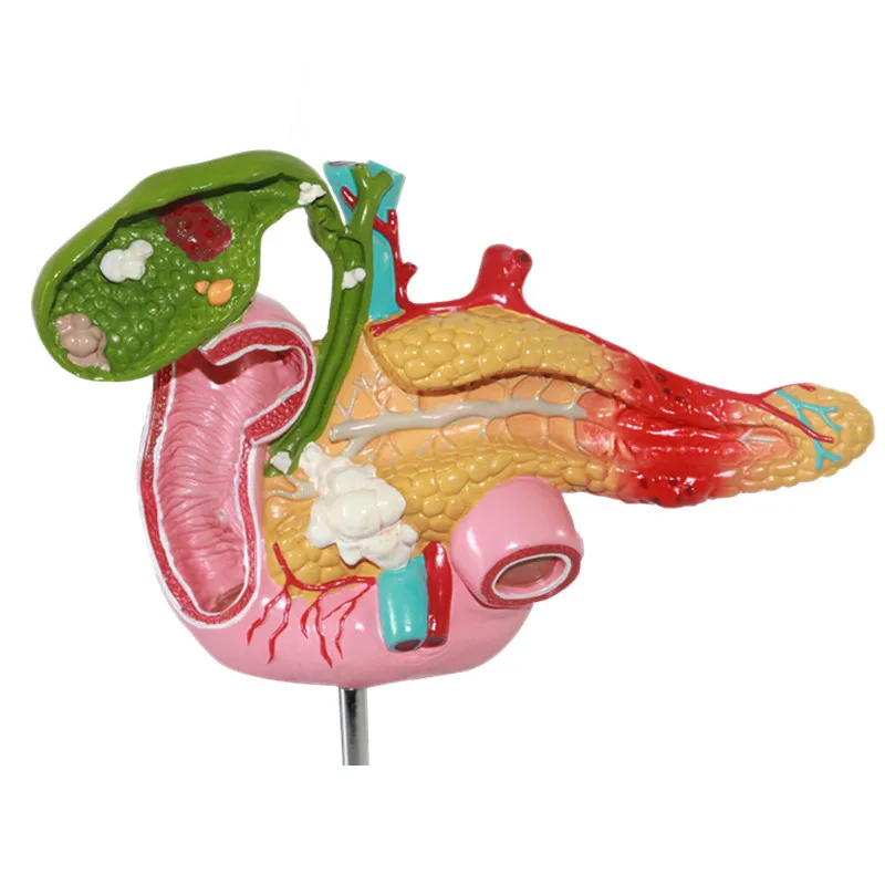 1:1 размеры поджелудочной кишки желчного пузыря патологическая анатомическая модель Желчного Камня хирургическая пищеварительная система