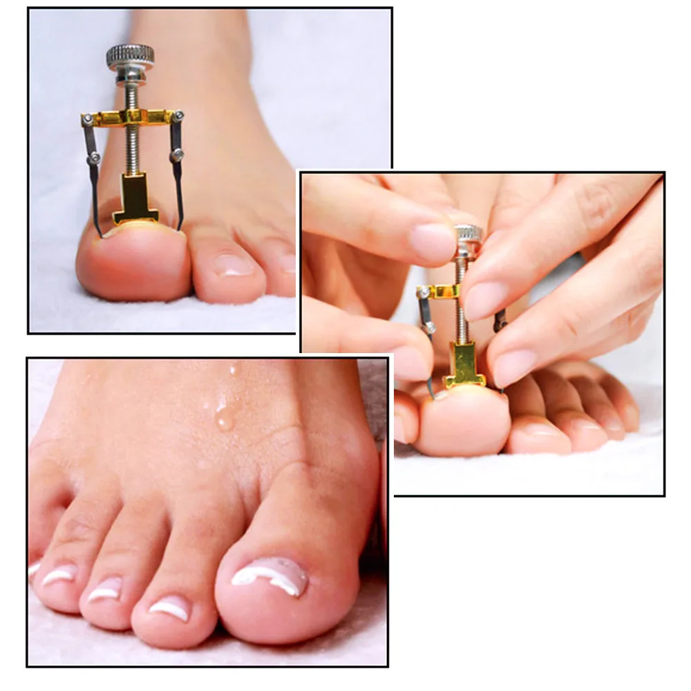 

Stainless Steel Ingrown Toe Nail Correction Tool 10Pcs Nail Correction Patch Pedicure Toenail Fixer Foot Nail Care n# dropship