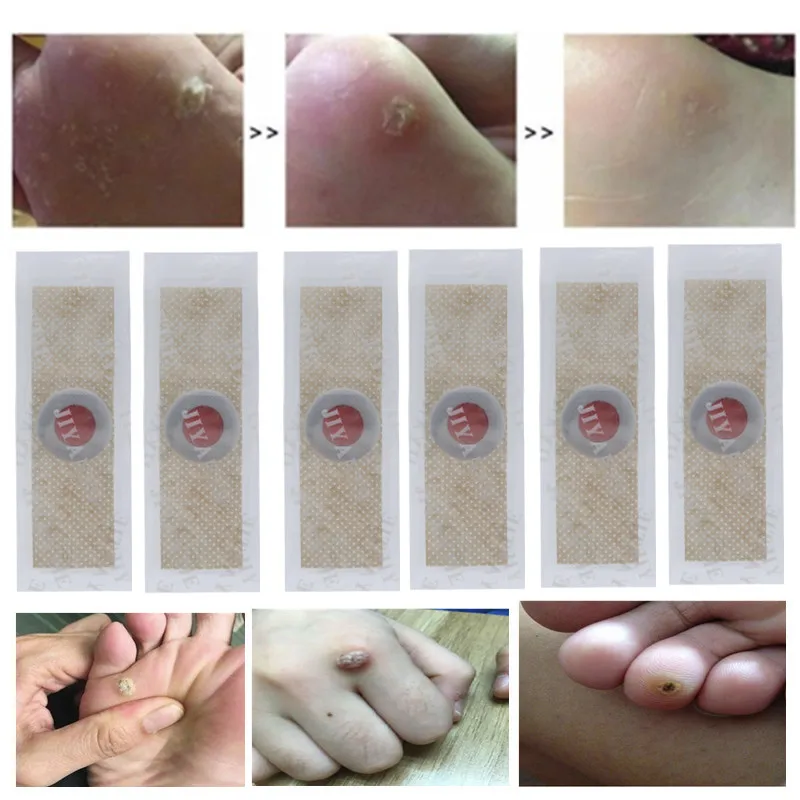 

40pcs Foot Corn Killer Calluses Plantar Warts Thorn Pain Relief Plaster Foot Care Tool Medical Sticker Toe Protector New Arrival