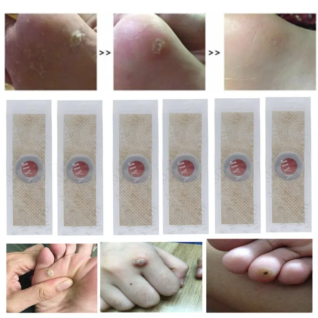 40pcs Foot Corn Killer Calluses Plantar Warts Thorn Pain Relief Plaster
