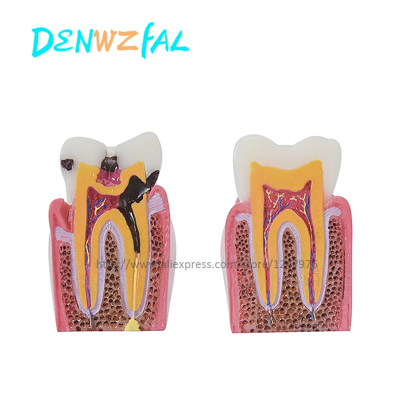 

Six-fold dental caries contrast model dental decay demonstration model sectional model doctor-patient communication for teaching