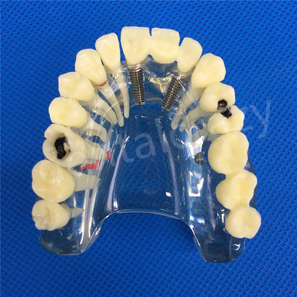 Стоматологический имплантат верхняя модель челюстей с мостом и кариес Стоматологическое исследование Обучающие модели зубные Стоматологические материалы