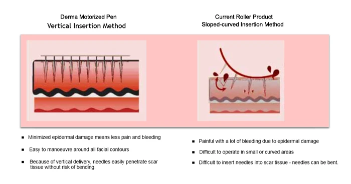 фракционная мезотерапия дермапен. Amg517 прибор для ухода и массажа лица nanopen (розовый) gezatone. дермапен m1. микроигольчатая терапия дермапен. дермапен аппарат.