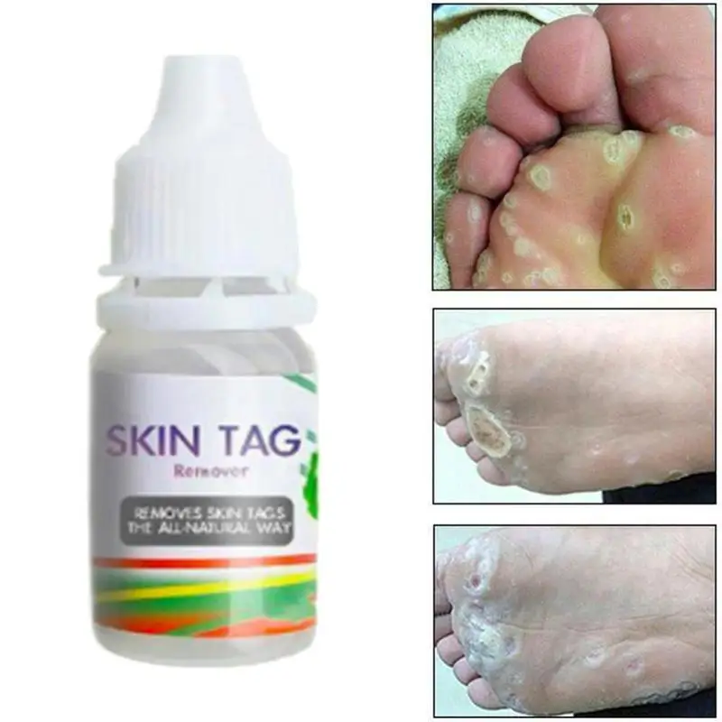 10ml Body Warts Treatment Cream Skin Tag Remover Foot Corn Removal Plantar 843681136954 Ebay