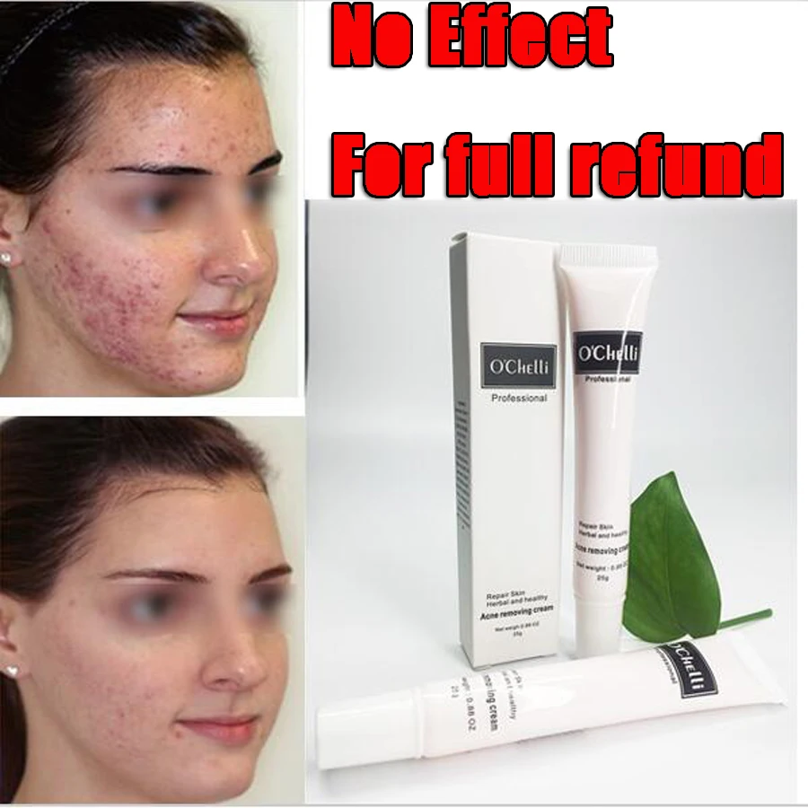 Really effective Acne Treatment Blackhead Remova Anti Acne Cream Oil