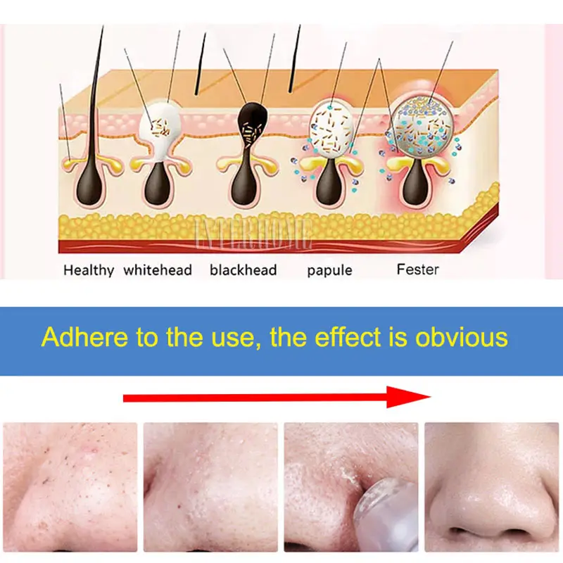 Blackhead-Remover-0899-2(10)
