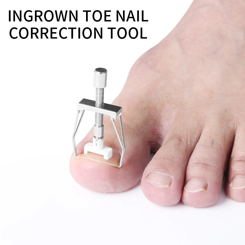 

Ingrowning Toenails Pedicure Corrector Ingrown toe nail correction tool