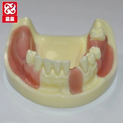 Falta de Simulação do Modelo de Implantes Dentários Dentes Perdidos Frete Grátis