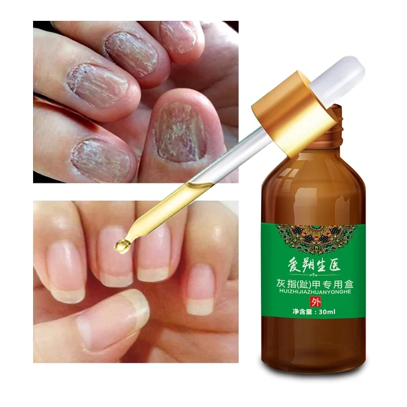 

Fungal Nail Treatment Feet Care Toe Nail Fungus Remove Anti Infection Paronychia Onychomycosis Healthy Toenail Growth Newest