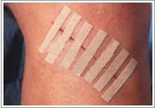 50pcs 6mm 100mm medical adhesive sterile wound skin closure
