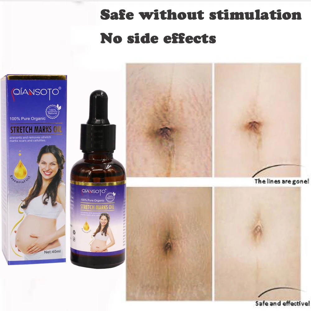 

Pregnancy Stretch Mark Removal Essential Oil Effective Maternity Natural Chinese Herbal Repairing Oil Get Rid Stretch Mark 40ml