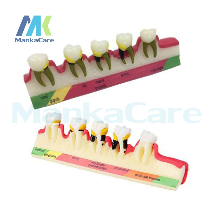 Стоматологическая модель периодонтальное заболевание Assort Tooth Типографа 2 типа