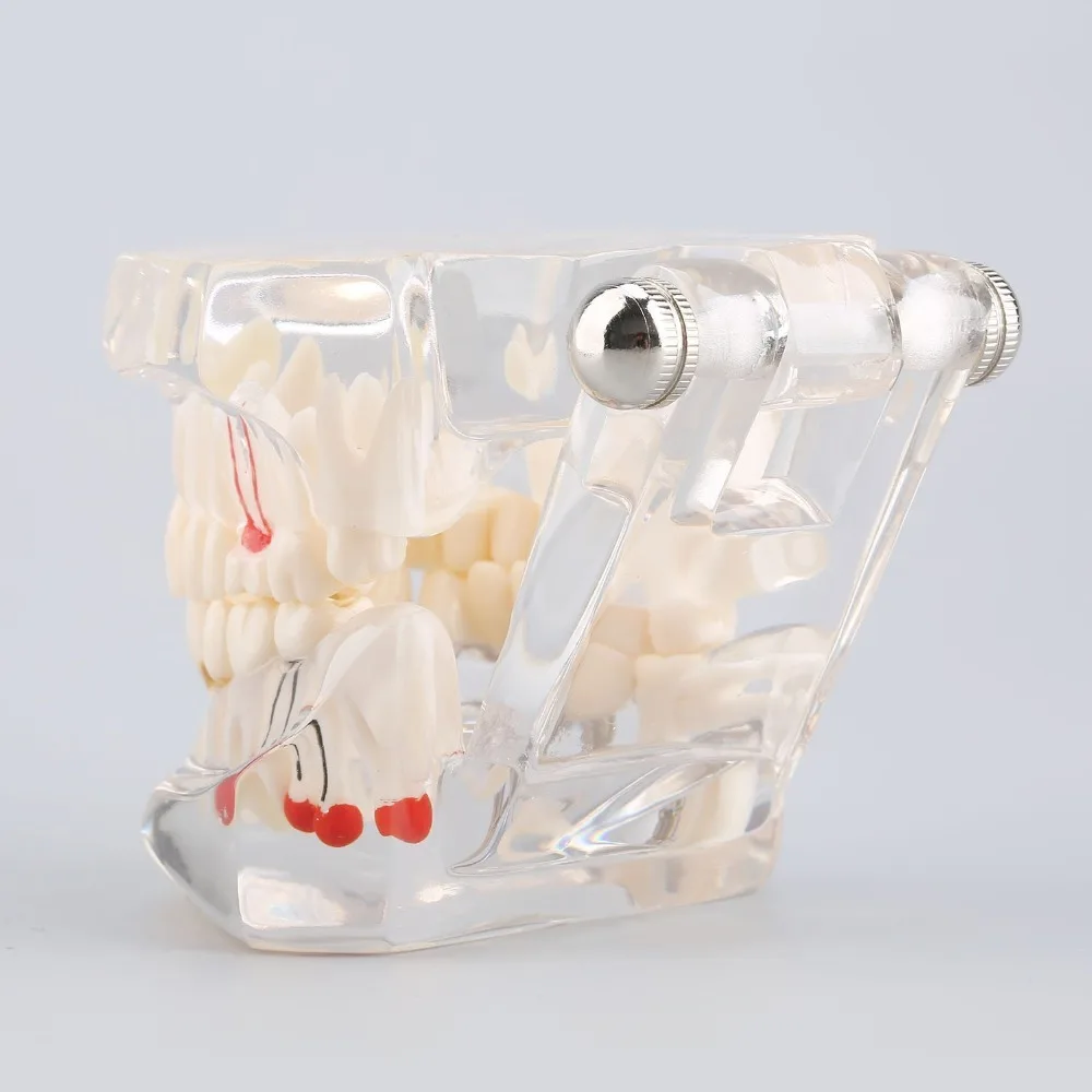 Прозрачный взрослых патологий стоматолог Имплантат Демонстрация Пародонтоз разбирают зубов и десен зуб Средства ухода за мотоциклом