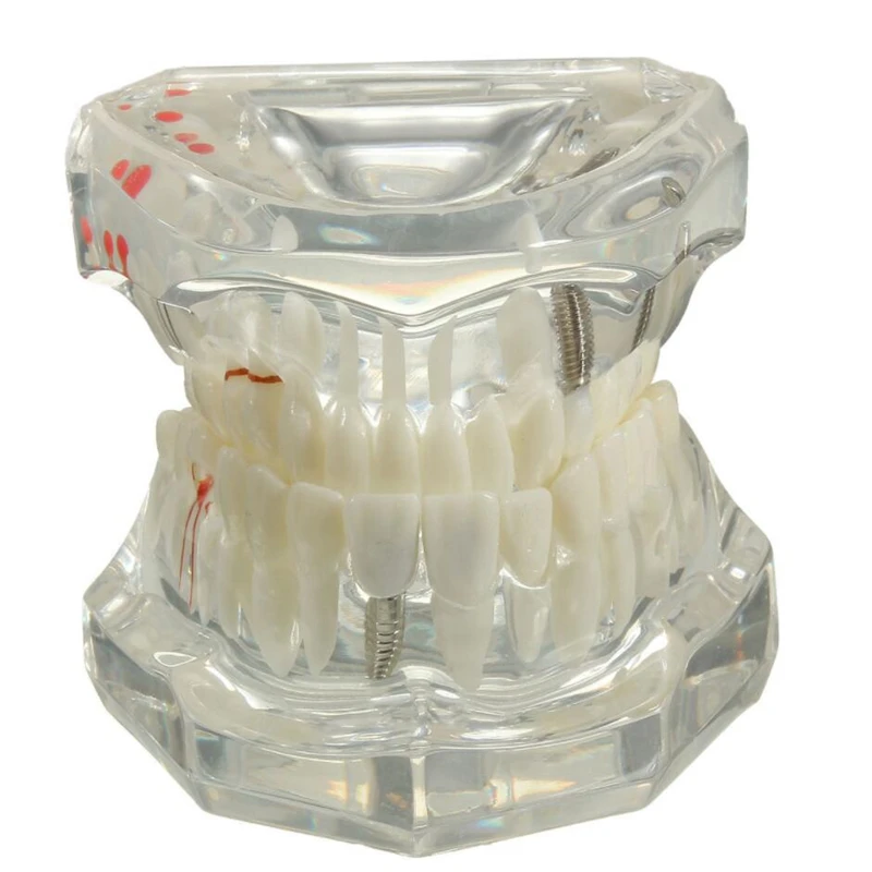 Dental Implant Disease Teeth Model With Restoration Bridge