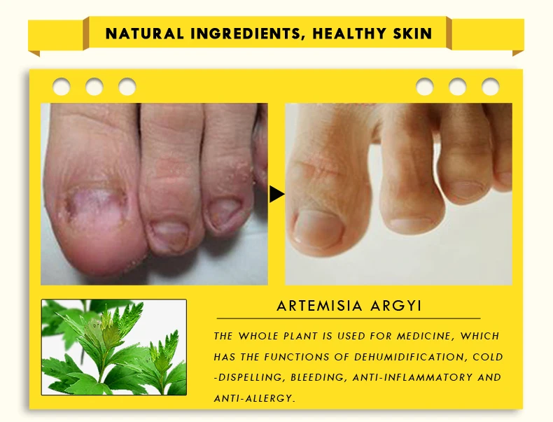 2 шт. травяная Лечение ногтей онихомикоз параонихиа противогрибковые инфекция ногтей хороший результат Китайский травяной носок Лечение ногтей