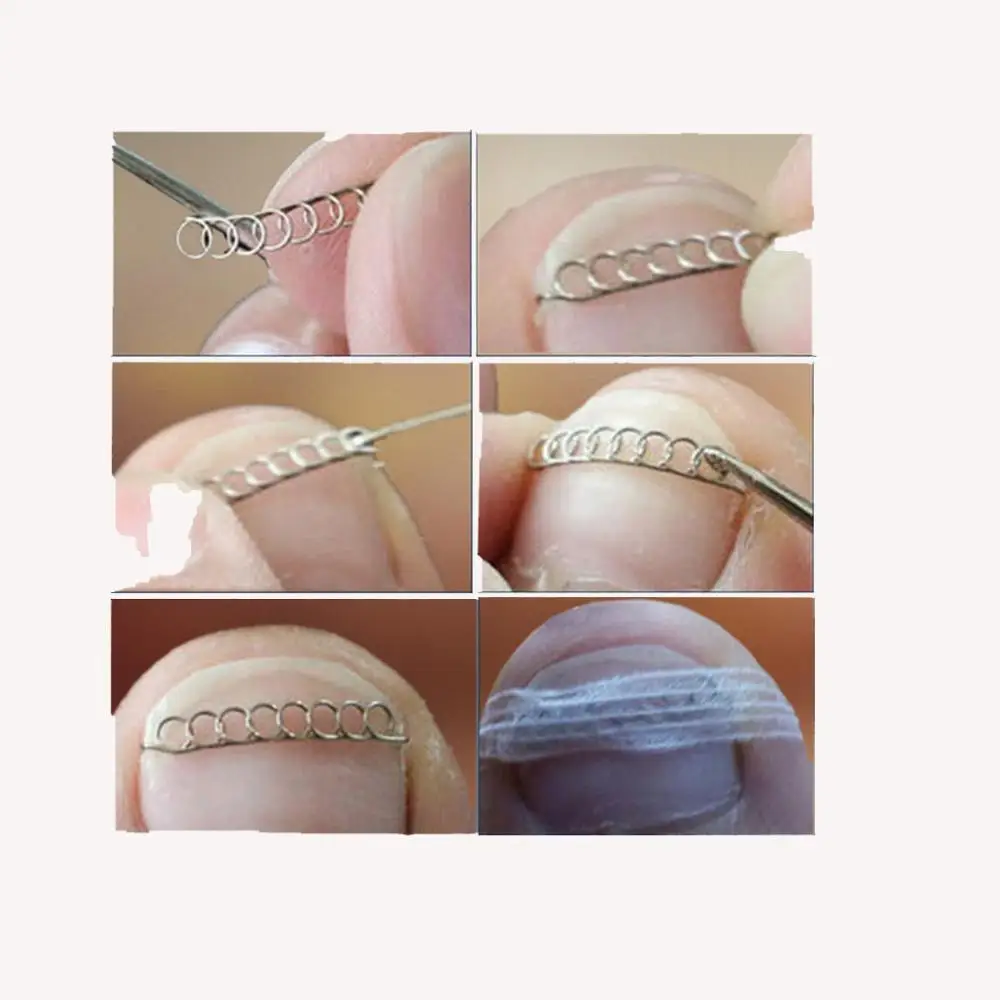 Kesoto Ingrown Toe Nail Correction pro Foot Nail Orthotic Manicure Toenail Corrector Stickers Bunion Corrector Foot Care Tools