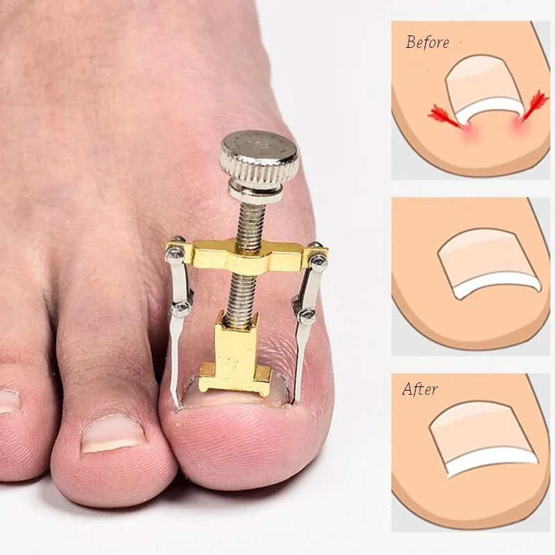 Педикюр, инструмент для ухода за ногами, вросший носок, корректор для ногтей, профессиональная пароникция, чироподы, инструменты для ремонта ногтей