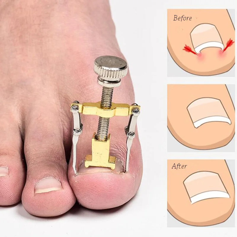 Pedicure Foot Care Tool Ingrown Toe Nail Corrector Professional Paronychia Chiropody Podiatry Repair Nail Treatment Tools