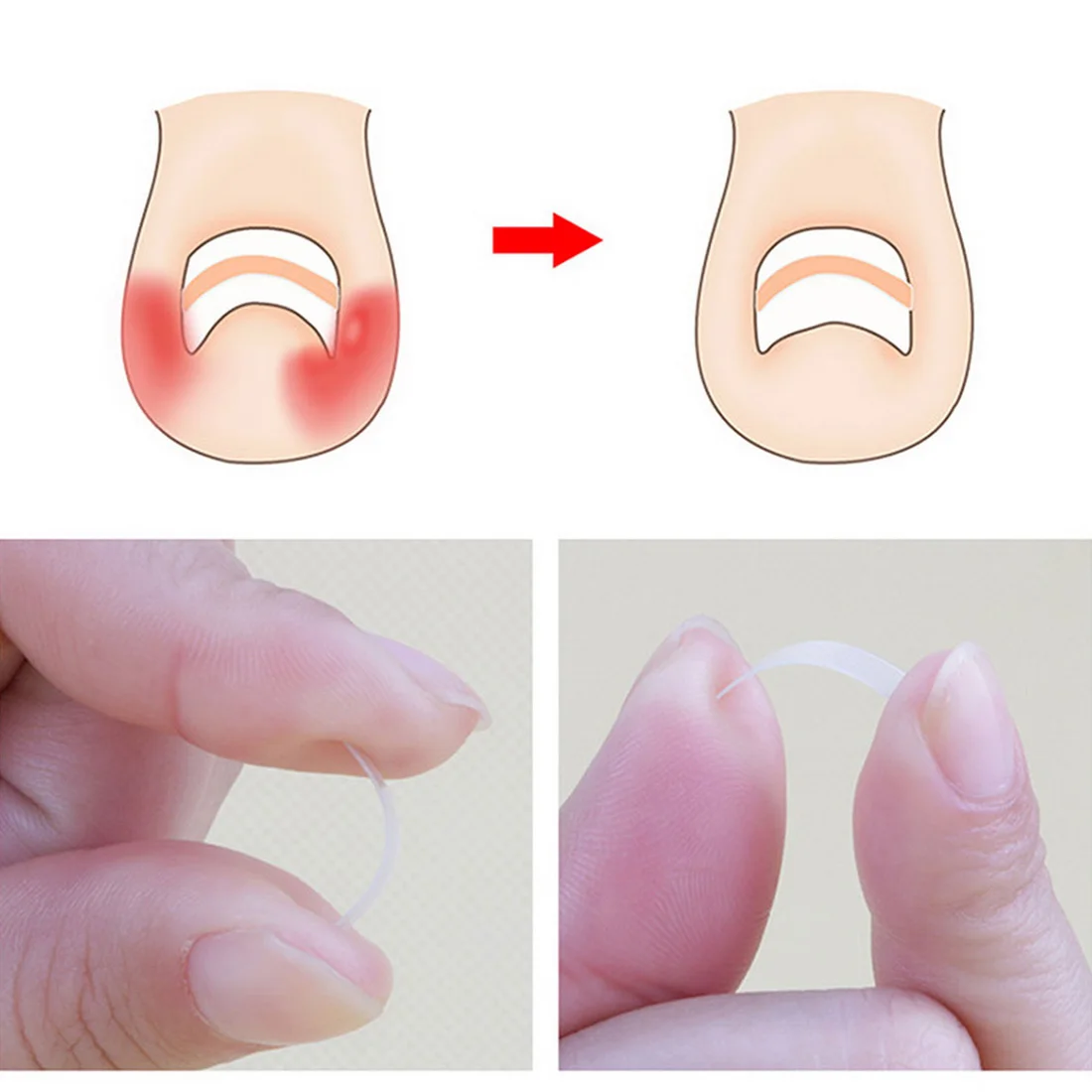 Paronychia Correction File Elastic Patch Corrector Treatment Tools 10pcs/box Toe Nail Ingrown Correction Sticker Patch Foot Care