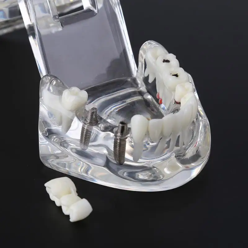 Зубной имплантат, модель зубов для медицинского обучения, гигиена полости рта с восстановлением моста палочки для очистки зубов
