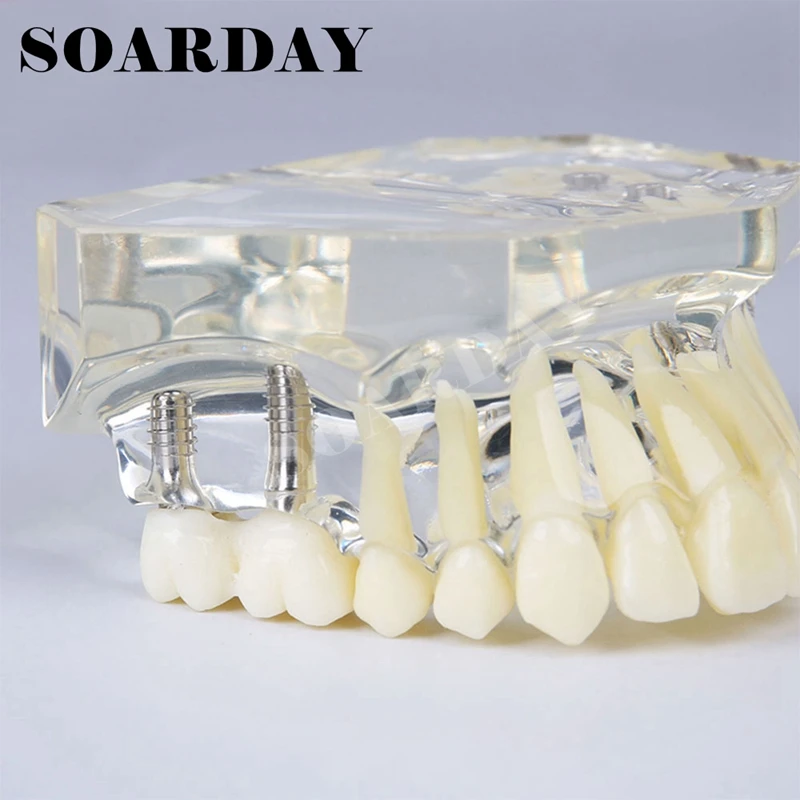Upper Teeth Implant Dental Model with Bridge for teaching or communicaton (5)