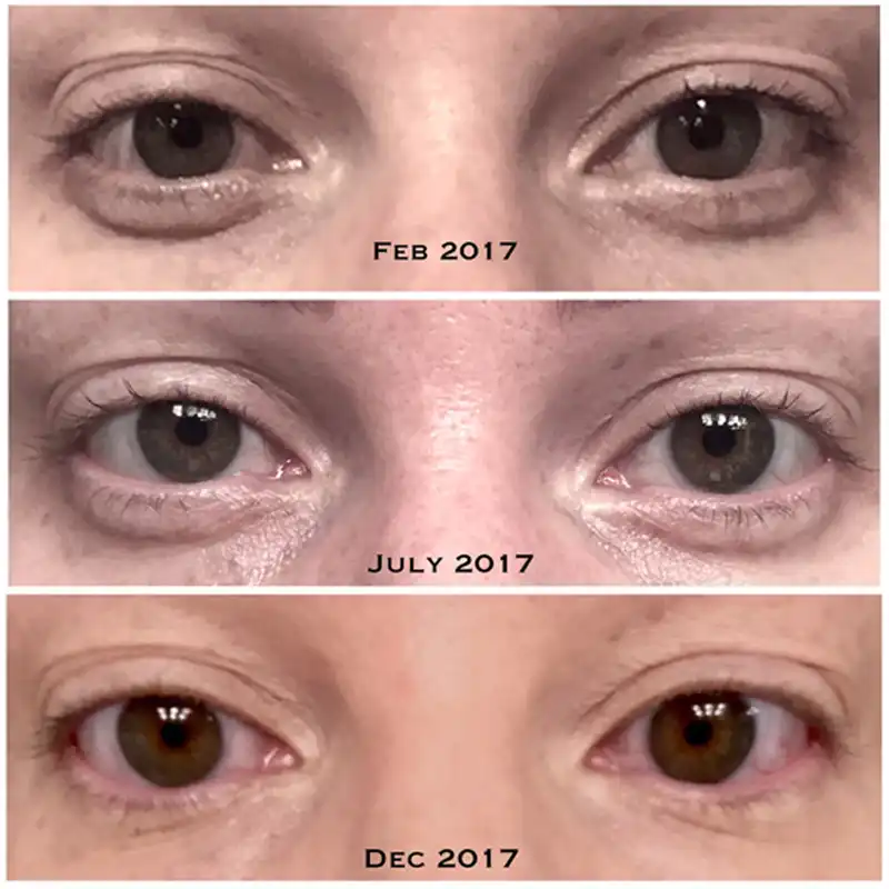 the ordinary for eye wrinkles