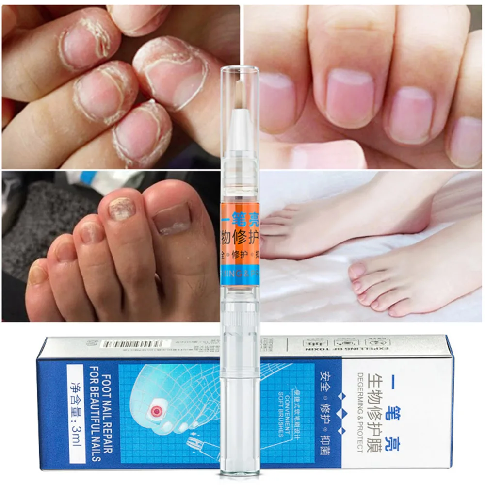 3ml Fungus Nail Treatment Liquid Anti Fungus Hand Foot Care Nail