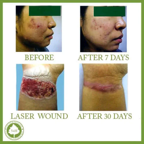 body acne scar removal cream body acne scar removal cream