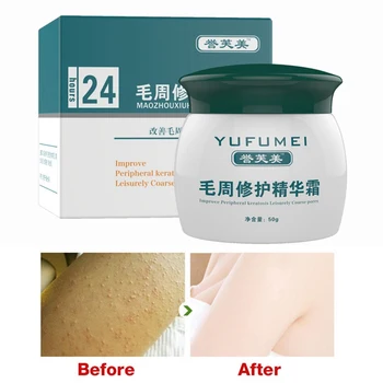 

50g Curing Keratosis pilaris/ kp/ Chicken Skin Body Lotion Skin Repair Cream