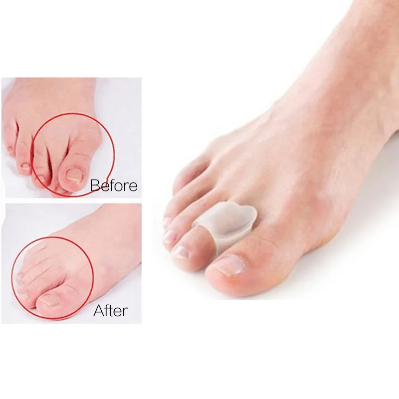1Pair silikon Gel Pemisah Jari kaki Toe Bunion Pengawal Penyakit Hati Pelindung Toe Hallux Valgus Pembetulan Posture Foot Care Pedicure