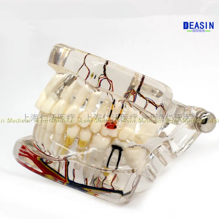 Goede Hoge Kwaliteit Dental Tanden Model Transparante Pathologische Implant Zenuw Model Reparatie Model Onderwijs Demonstratie Model
