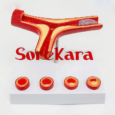 

Human Anatomical Vascular Atherosclerosis Pathology Medical Organ Teach Model School Hospital