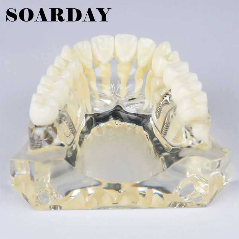 Верх зубы имплантатов зубные модель с моста для обучения или коммуникационное