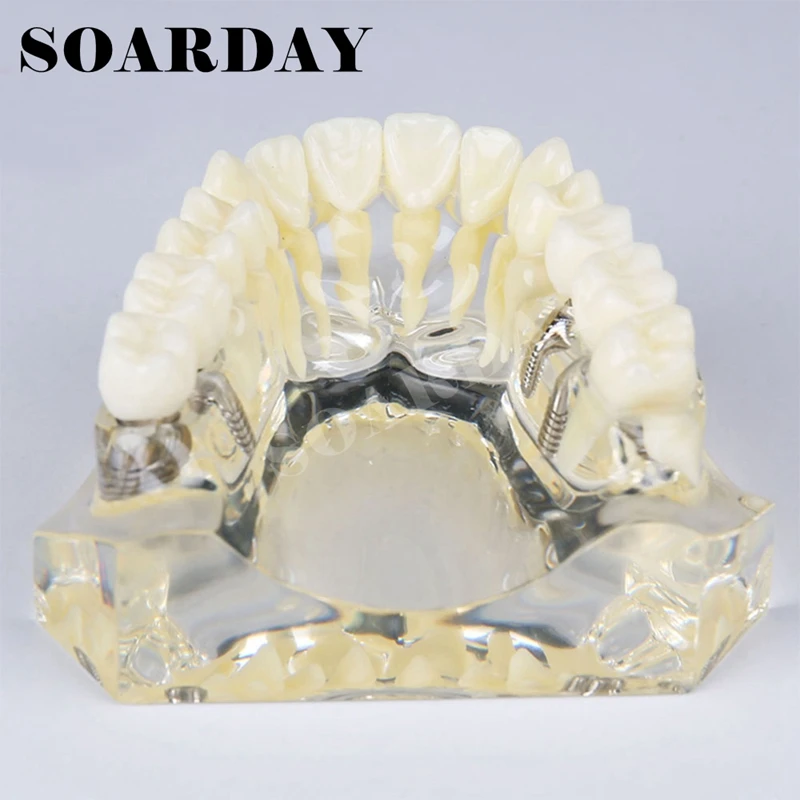 Upper Teeth Implant Dental Model with Bridge for teaching or communicaton (2)