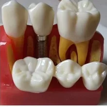 4 раза стоматологический имплантат анализ Корона мост демонстрация Стоматологическая модель зубов