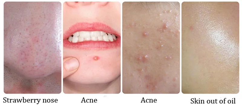 blackhead8874565 (13)
