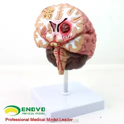 ENOVO медицинский человека. Мозг болезни модель мозга модель нейрохирургии кровоизлияние в