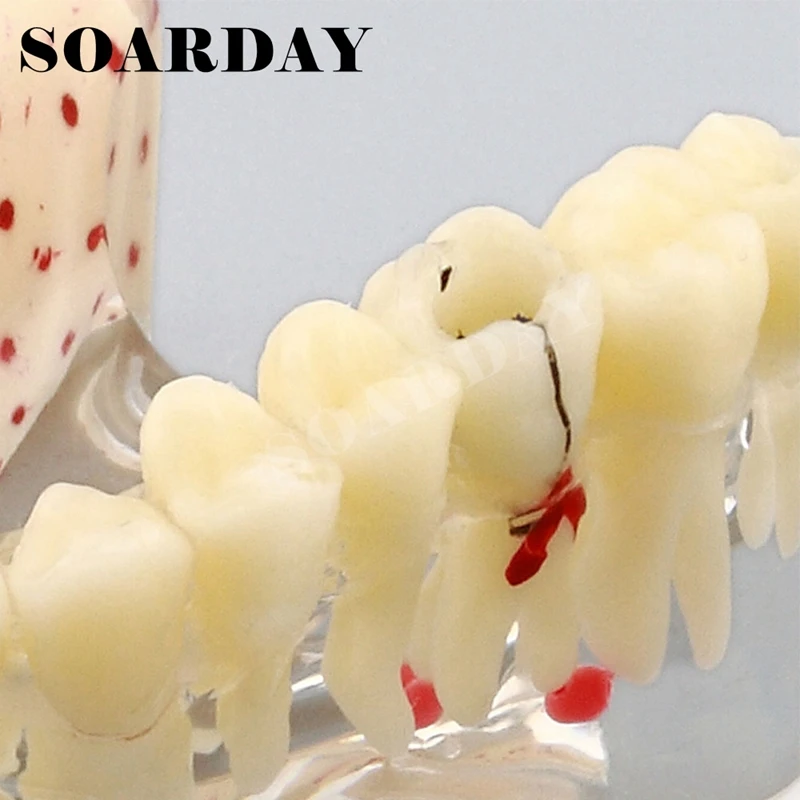 Implant Dental Model for Upper teeth Implant Spongy Bone Carious (5)
