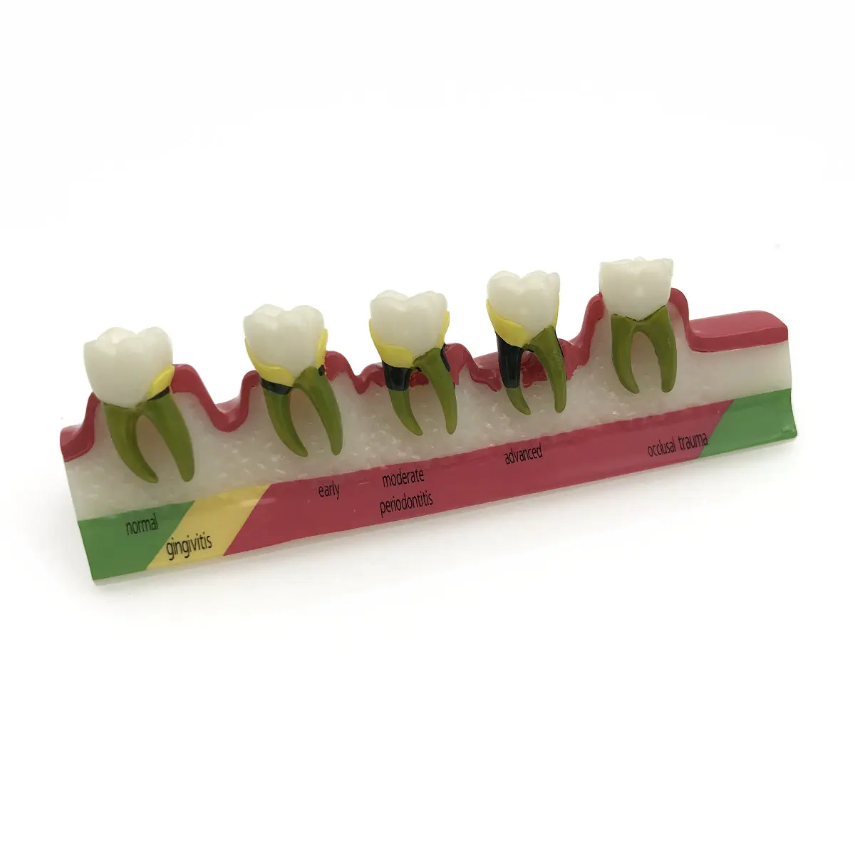 

Free Shipping Dental Periodontal Disease Assort Tooth Typodont Model