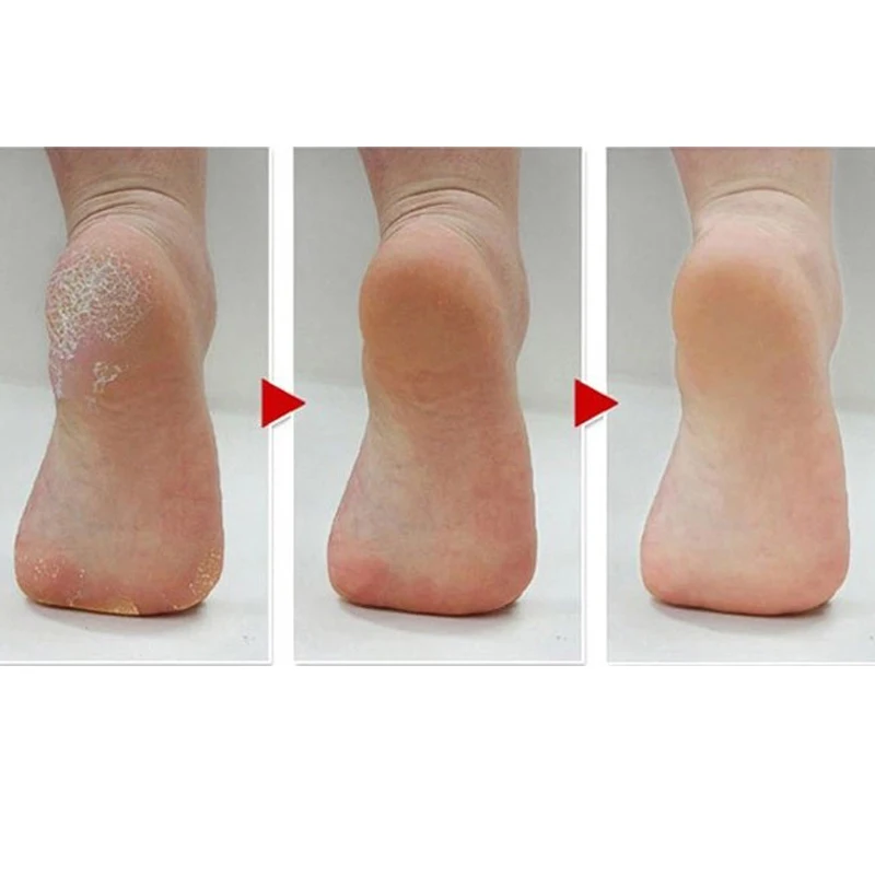 Электрический пилинг для ног rasp callus remover Педикюр для ног шлифовальный станок для удаления мертвых сухих твердых трещин кожи и мозолей