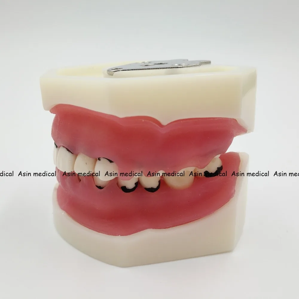 Modelo de Aprendizagem Modelo de Doença Deasin Novo Dentista Periodontal Dente - Modelo Médico 9 Clareamento dos dentes