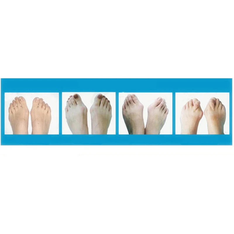 Sub-Toe Toe Braces Toe Separator Orthoses Thumb Big Feet Device Pad Foot Care Silica Gel Toes Separation Thumb Valgus Corrector